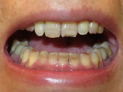 前歯の欠け (1)