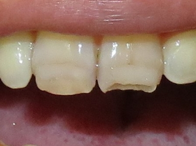 前歯の欠け (2)